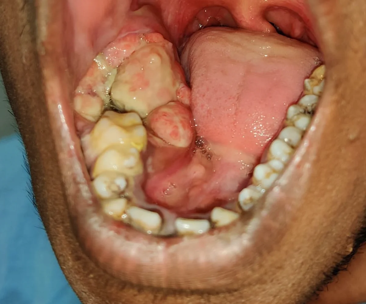 Ameloblastoma jaw tumor pre-operative presentation