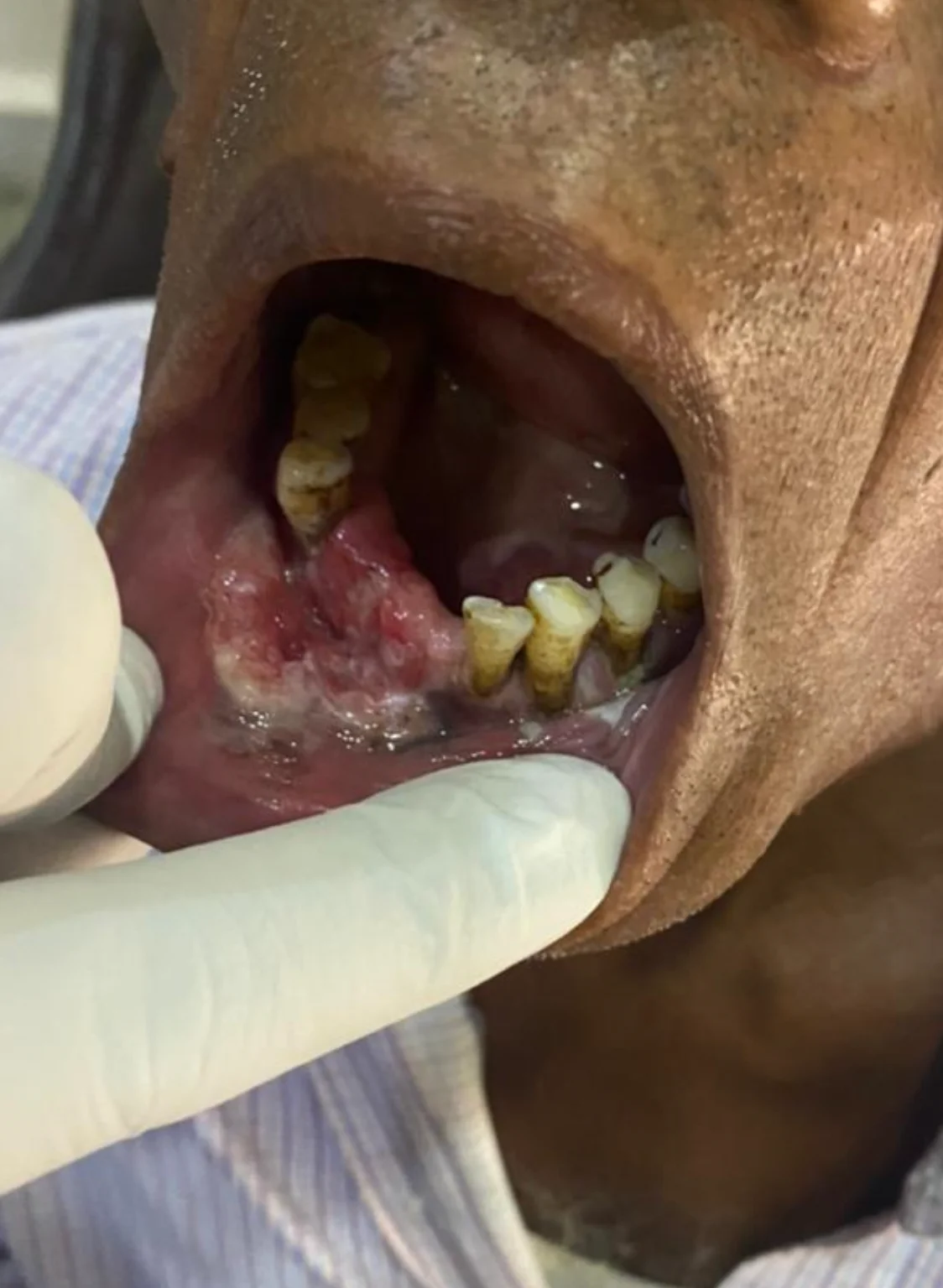 Oral cancer pre-operative presentation