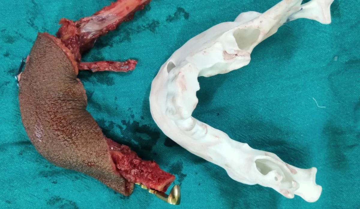 Fibula bone contoured for mandible reconstruction