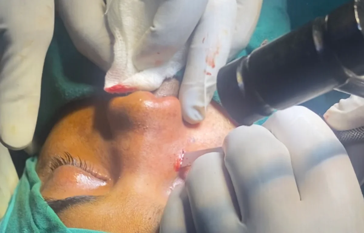 Nasal fracture pre-operative presentation
