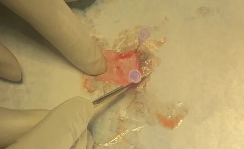 Temporal fascia graft harvest