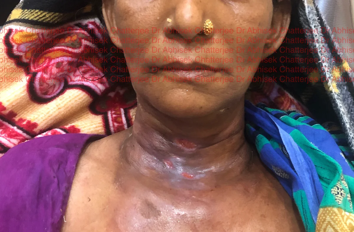 Neck space infection post-operative result