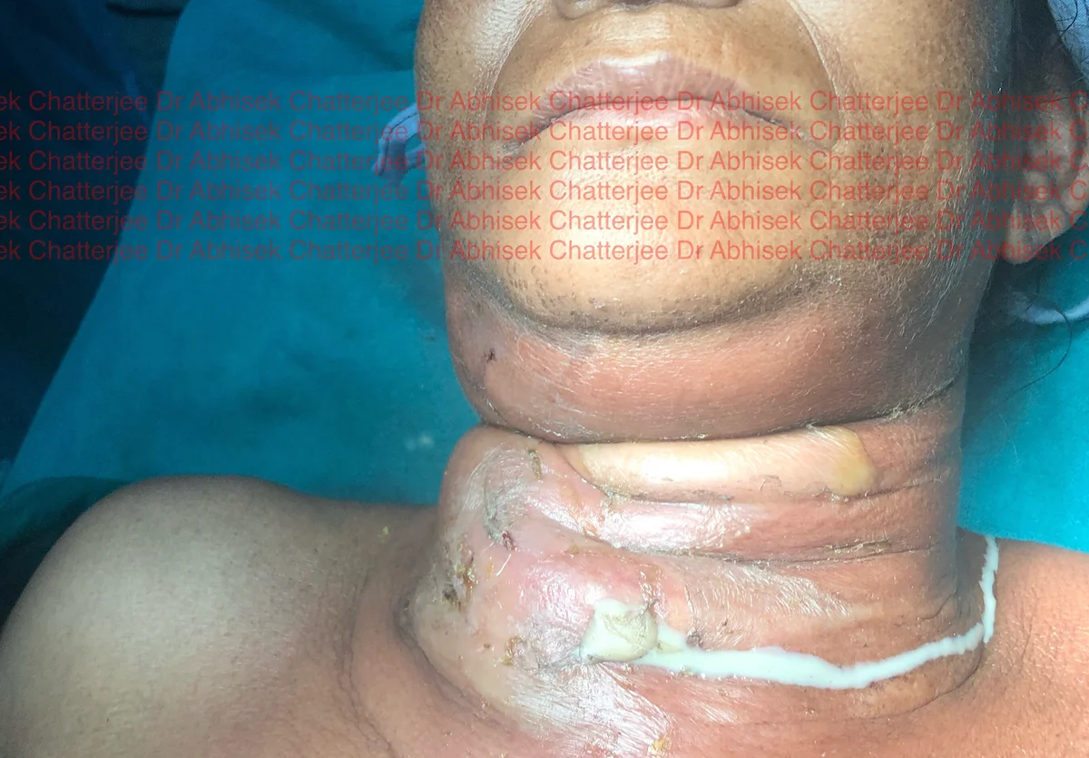 Deep neck space infection pre-operative