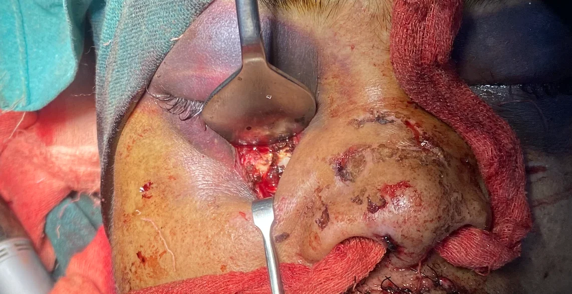 Infraorbital plate fixation