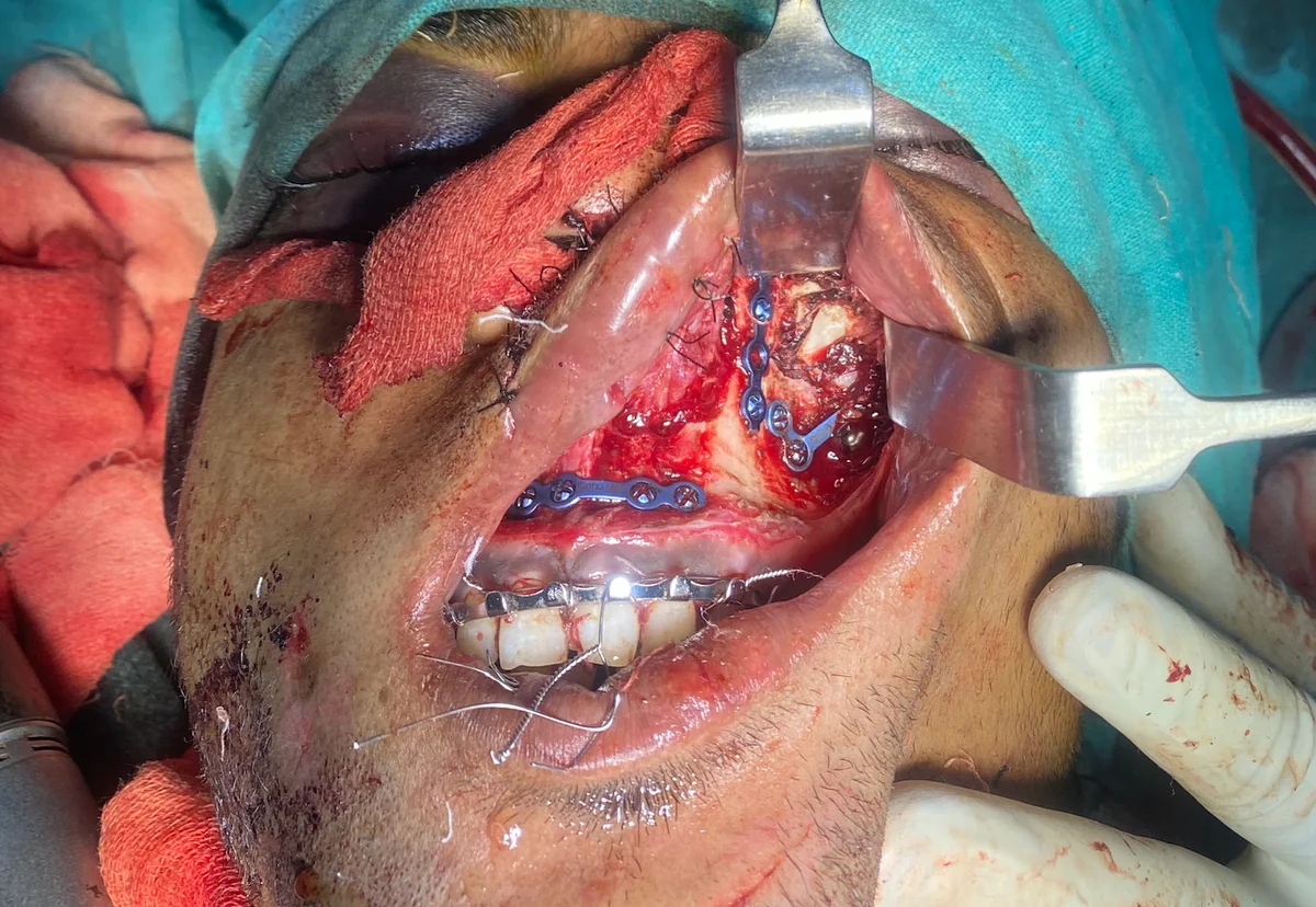 Left maxillary plate fixation
