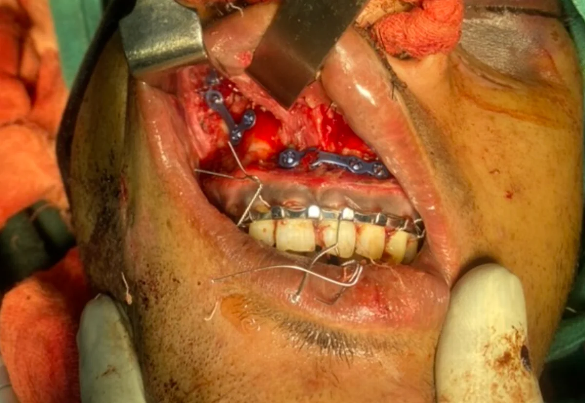 Right maxillary plate fixation