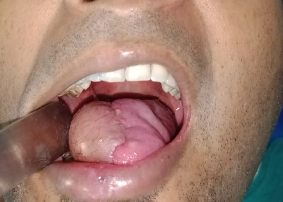 Tongue cancer surgery post-operative result