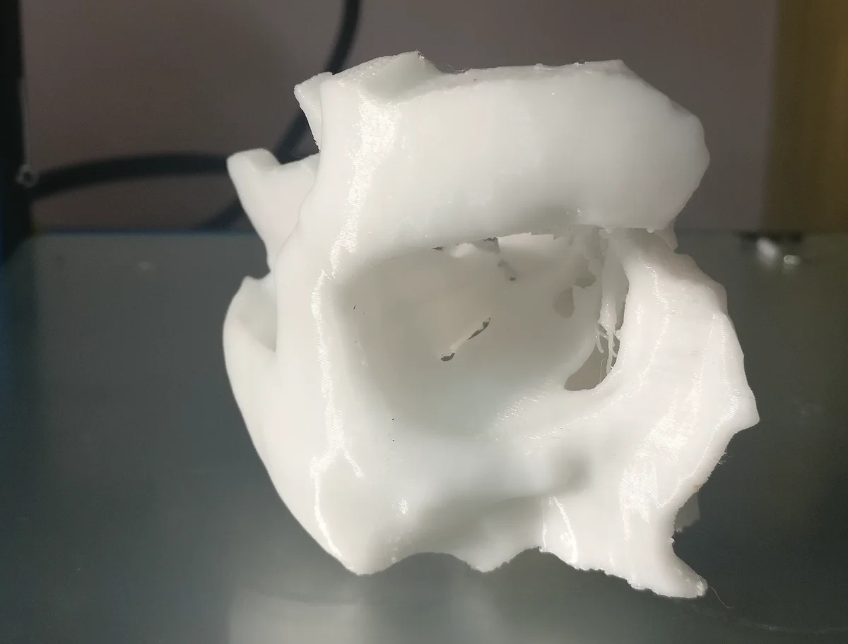 3D printed model of zygomatic fracture